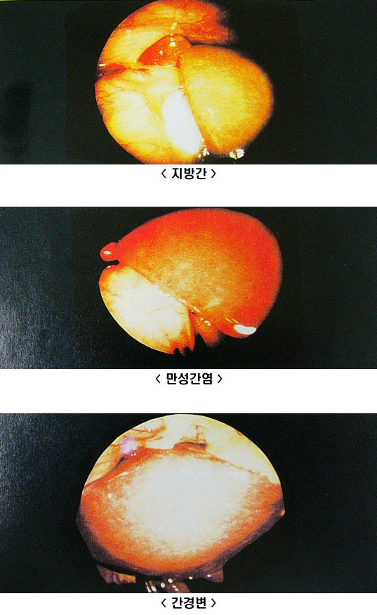 지방간[지방.콜레스테롤]빼는법 - 1